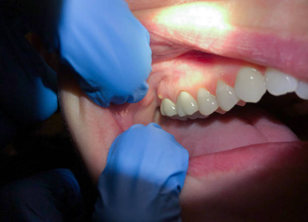 Best Teeth Whitening  in Upton, WY