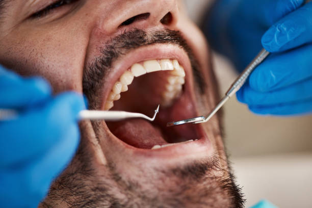 Best Dentist for Tooth Abscess  in Upton, WY